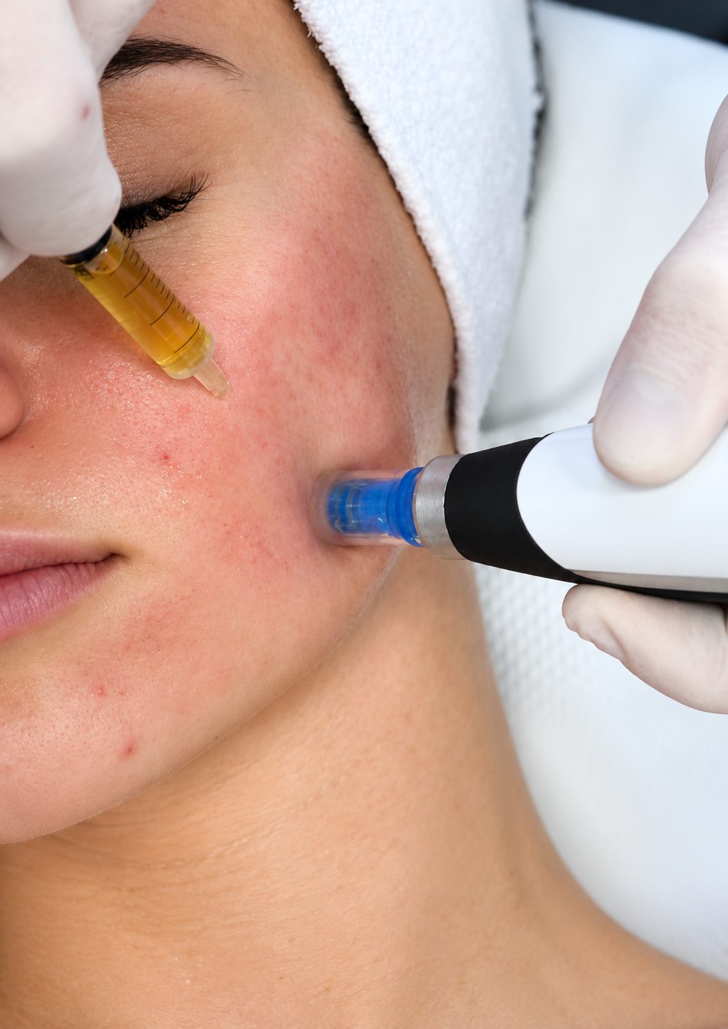 Microneedling