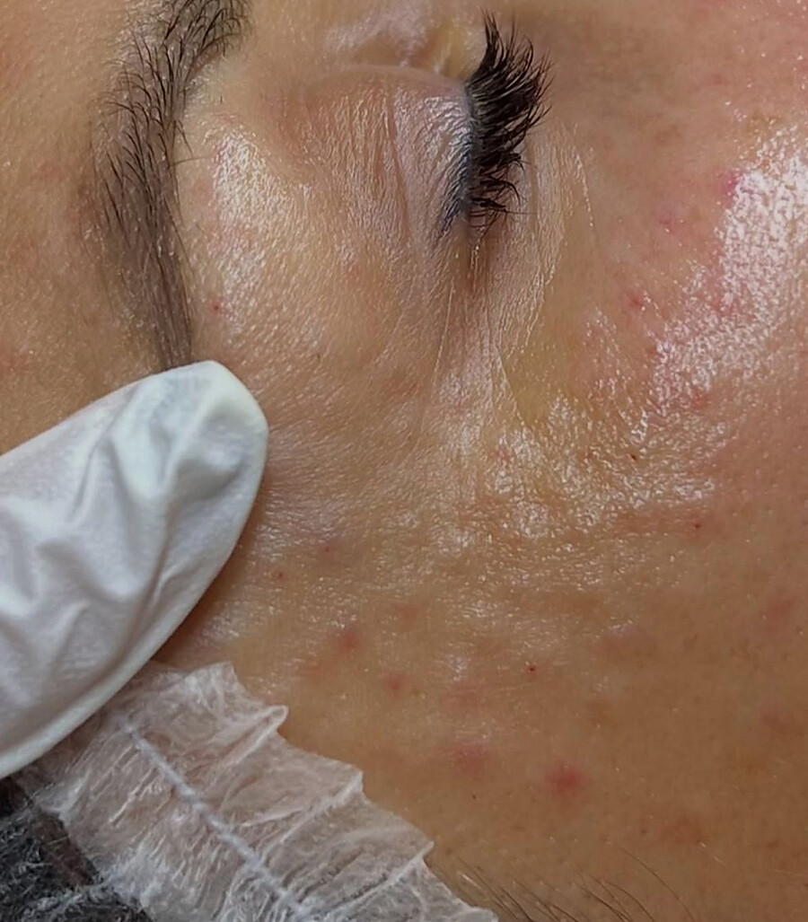 PRP Injections